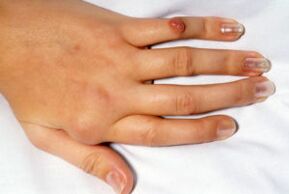 bolovima zglobova prstiju