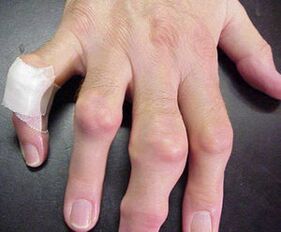 artroza liječenja prstiju)