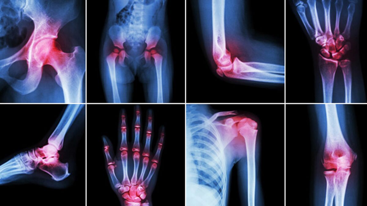 brzo ublažavanje boli u zglobu koljena magnetoterapija protiv bolova u koljenu