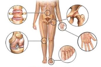 liječenje posttraumatskog artritisa i sindroma artroze)