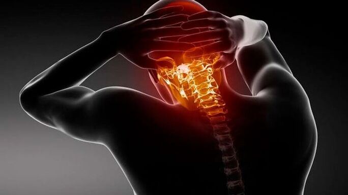 glavobolje s cervikalnom osteohondrozo