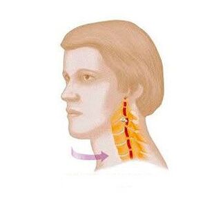 vertebralni sindrom s cervikalnom osteohondrozo