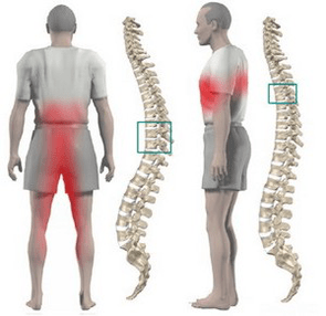 bol u leđima u torakalnoj osteohondrozi