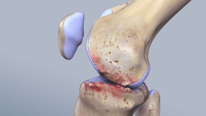 Struktura zgloba koljena zahvaćena patologijom