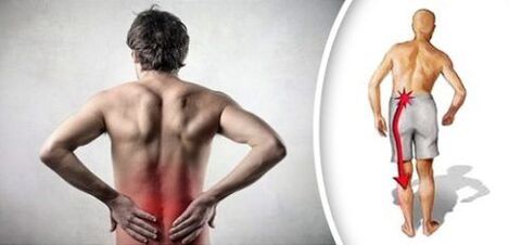 Sindrom boli s lumbalnom osteohondrozom zrači na noge