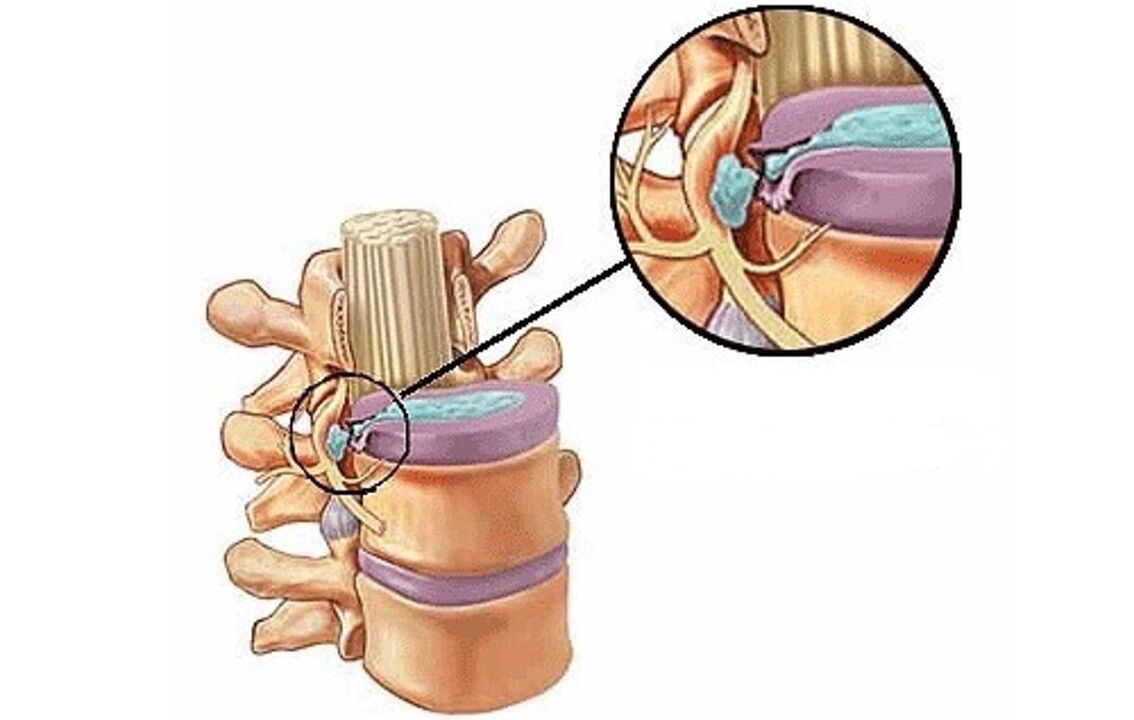 intervertebralna kila s torakalnom osteohondrozom